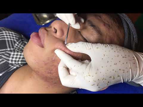 MIU SPA | Tratamento acne #1