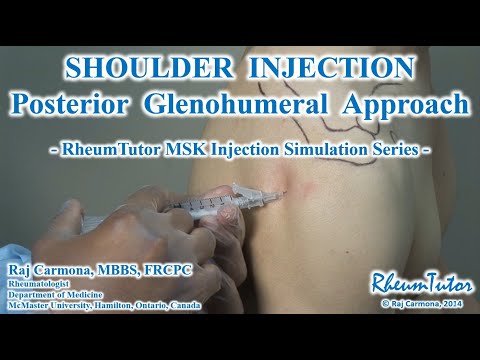 SHOULDER (GLENOHUMERAL) INJECTION - POSTERIOR APPROACH: Step-By-Step Instructions