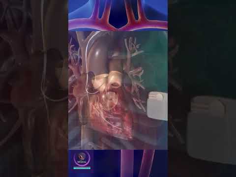 How a Pacemaker Works #shorts #education