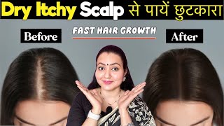 Dry Scalp Treatment At Home | Itchy Flaky Scalp से पाएं छुटकारा और पाएं Fast Hair Growth 💕