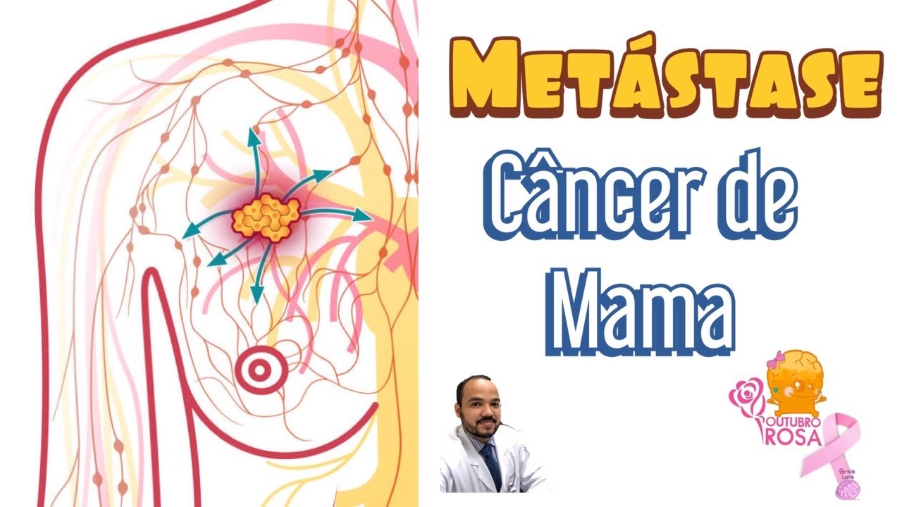 Metástase do Câncer de Mama Tem cura