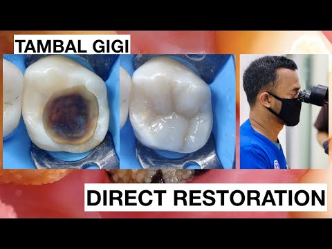 Dental Filling Composite Direct Restoration Upper Molar