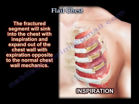 Flail Chest - Everything You Need To Know - Dr. Nabil Ebraheim