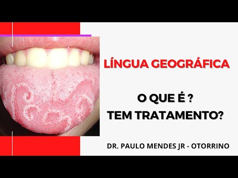 Língua geográfica e fissurada: o que é , sintomas e tratamento?