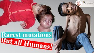 5 Real People who Baffled Scientists!! Rarest Mutations! ~Body Bizarre