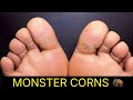 SHAVING TWO MONSTER CORNS