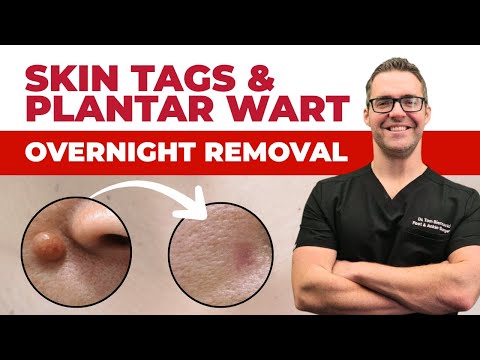 Skin Tags & Plantar Warts DISAPPEAR Overnight? [Best Home Remedies]