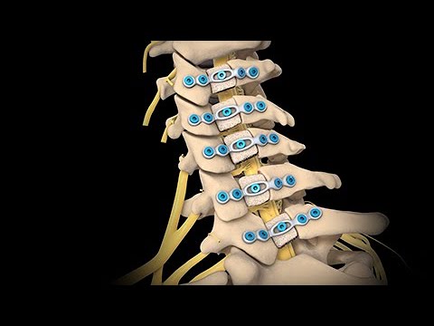 Watch the Neck Surgery - Cervical Laminoplasty animation on YouTube