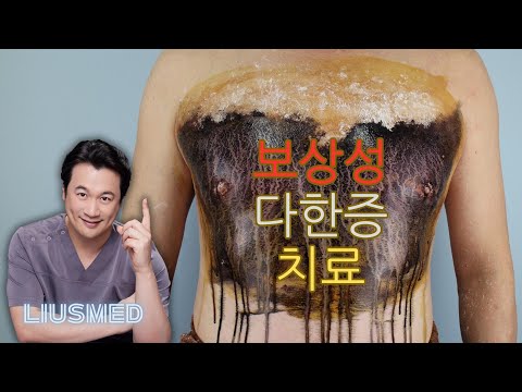 보상성 다한증 치료: 비침습적 땀샘 열분해