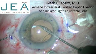 Download Lagu Kosko Light Adjustable Lens Yamane (LAL Yamane) Thumbnail