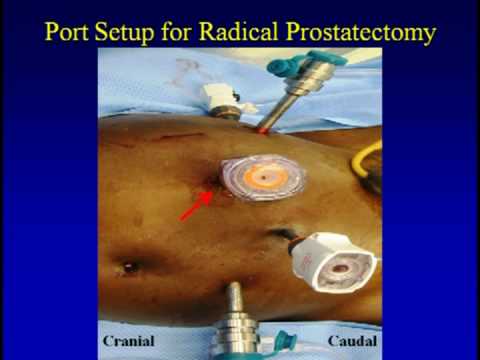 Nefrectomía parcial y prostatectomía radical asistida por un robot a través de puerto único