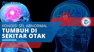 Tumor Otak, Kondisi Adanya Sel-sel Abnormal yang Tumbuh Tak Terkendali di Dalam atau Sekitar Otak