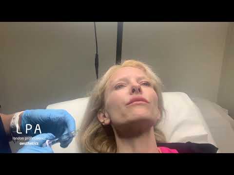 Lip enhancement using Juvederm Smile