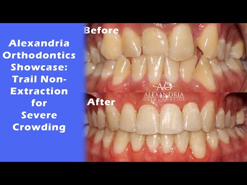 Alexandria Orthodontics Showcase: ⁠Trial nonextraction for severe crowding⁠