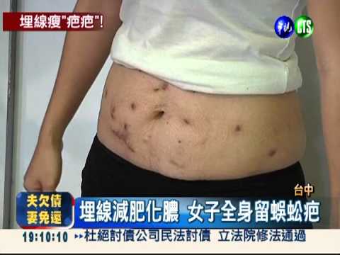 埋線全身蜈蚣疤! 4女減肥怒指控