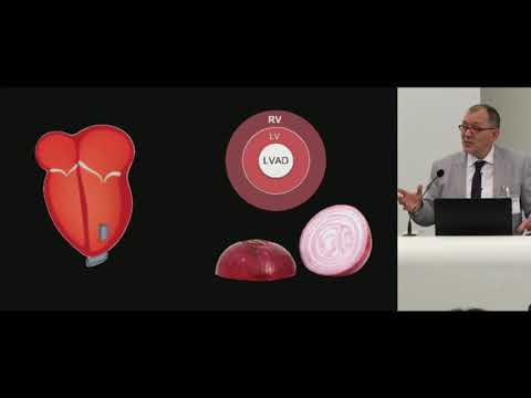 1.4 Perioperative TEE During LVAD Implantation & Weaning_Stefaan Bouchez