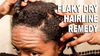 Natural Hair| Flaky & Dry Hairline Scalp Remedy|SCALP PSORIASIS??| BEAUTYCUTRIGHT