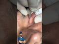 Scarless Xanthelasmas Excision From Eyelids Tayyabriazch