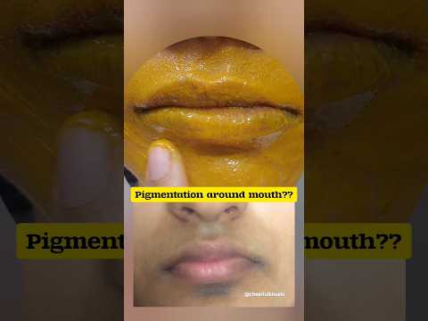 How to remove Pigmentation around mouth| Best remedy ✅️😌 #shorts #ytshorts #skincare #pigmentation
