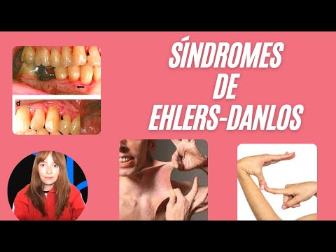 Síndromes de Ehlers-Danlos