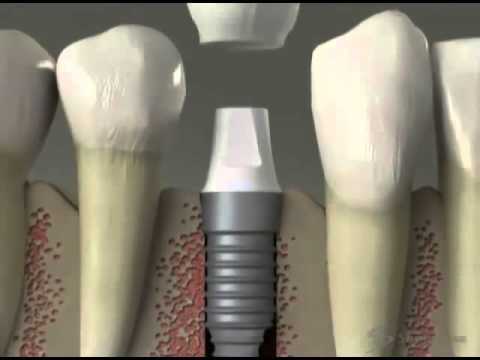 Caesy Dental Educational Video