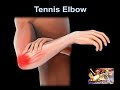 Tennis Elbow,  why it hurts?  Everything You Need To Know - Dr. Nabil Ebraheim