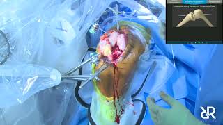 Dr. Stefan Kreuzer performs Total Knee Arthroplasty using the Think Surgical TCAT