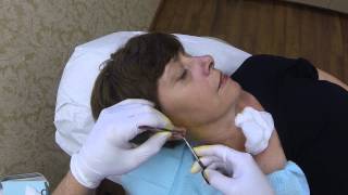 preview picture of video 'Adult Split Earlobe Repair | Huntington, Long Island NY Lebowitz Plastic Surgery'