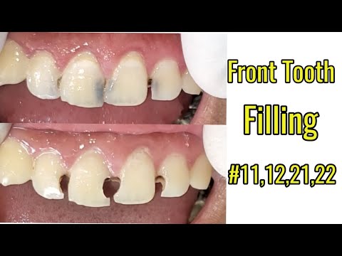 Front tooth filling #11,12,21,22