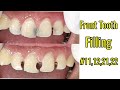 Front tooth filling #11,12,21,22