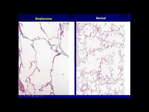 שיעור מחלות ריאה חסימתיות חלק 1 - COPD