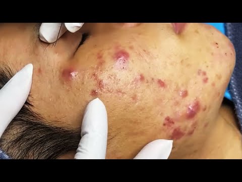Blackhead removal Video #126 #Blackheads #blackheadsremoval #sebum