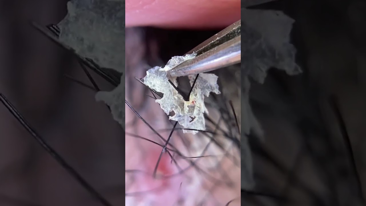 vol.16 "Moving" dandruff and scab picture book　動くフケ・角栓図鑑。#shorts