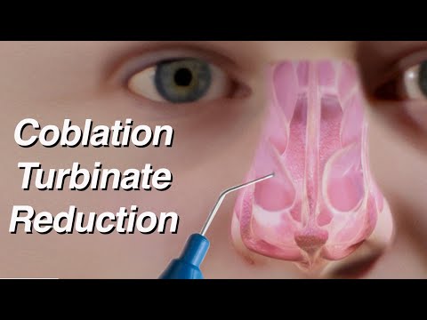 Coblation Turbinate Reduction to Treat Nasal Obstruction