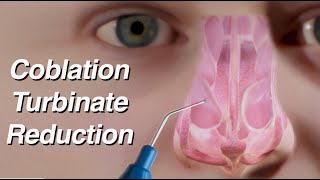 Coblation Turbinate Reduction to Treat Nasal Obstruction