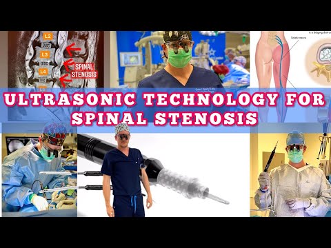 𝐔𝐥𝐭𝐫𝐚𝐬𝐨𝐧𝐢𝐜 Spine Surgery 𝐓𝐞𝐜𝐡𝐧𝐨𝐥𝐨𝐠𝐲 for Spinal Stenosis! 😀🧐🥳