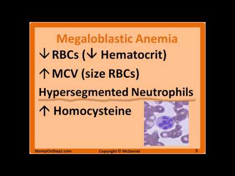 Folate & B12 Deficiency, Megaloblastic Anemia Hypersegmented Macrocytic Methylmalonic