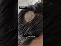 Treatment For Alopecia Areata With Ayurveda Dr Rekha