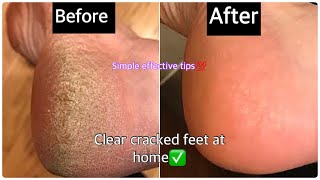 How to remove dead skin cells from your feet | get soft smooth feet at home