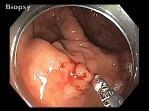 Cicatrice du Cæcum - Vue Endoscopique