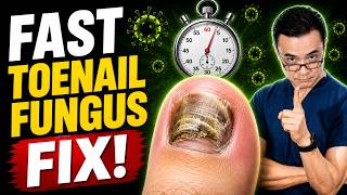 5 Toenail Fungus Home Remedies That Work FAST!