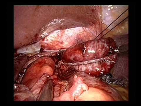 Escisión laparoscópica con una sola incisión del divertículo esofágico del tercio inferior