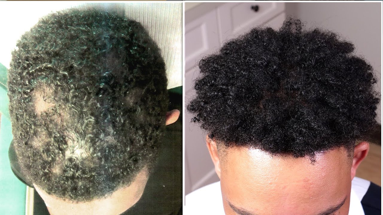 African American Hair Loss Hair Restoration Specialists of Atlanta