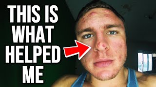 GET RID OF YOUR NOSE ACNE! (FROM EXPERIENCE)