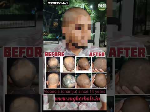 Stop Hair Fall – Real Customer Results
