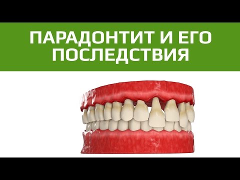 Атрофия костной ткани. Пародонтит, как причина потери зубов и атрофии кости