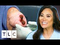 Dr. Lee Removes An Open Wounded Lipoma | Dr. Pimple Popper Pop Ups
