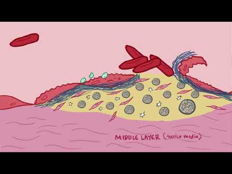 Arteriosclerosis, Atherosclerosis & Arteriolosclerosis  pathology