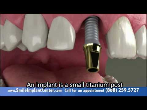 A Single Implant – Why replace missing teeth?