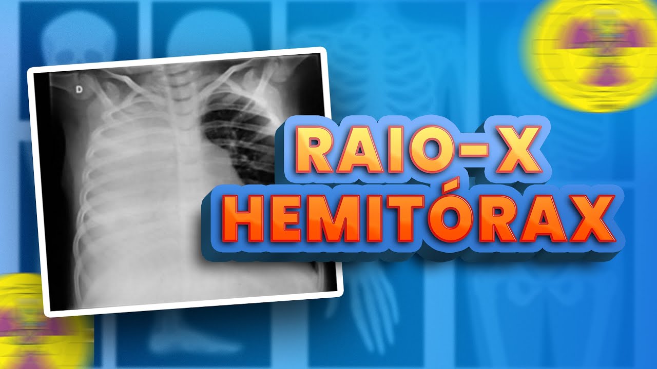 WHAT IS HEMITORAX X-RAY? | X-raying